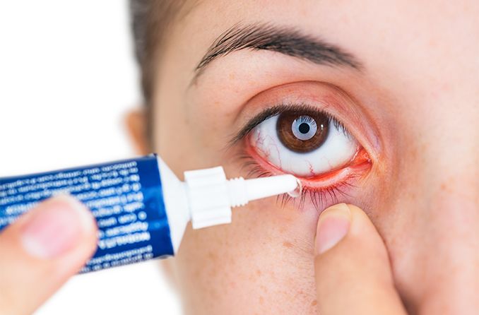 Frau, die Erythromycin-Salbe in ihr Auge einfügt