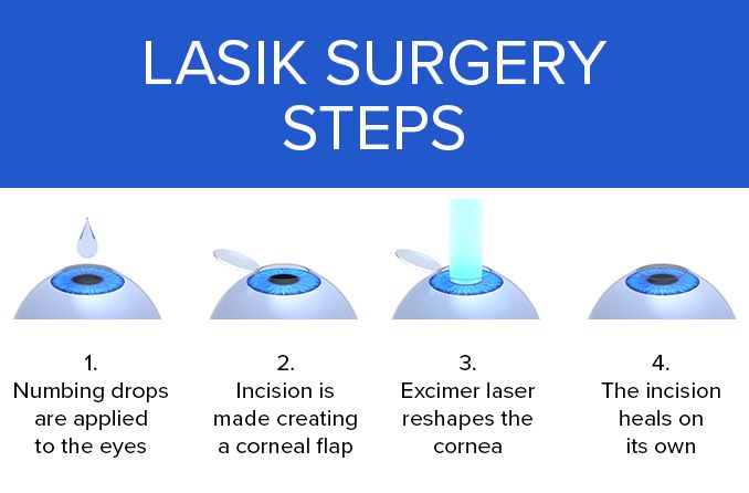 illustration of the 4 main lasik surgery steps