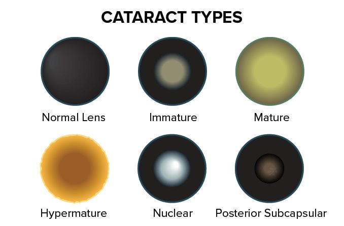 illustration of the different types of cataracts