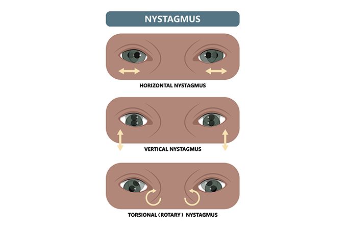 illustration of the 3 types of nystagmus