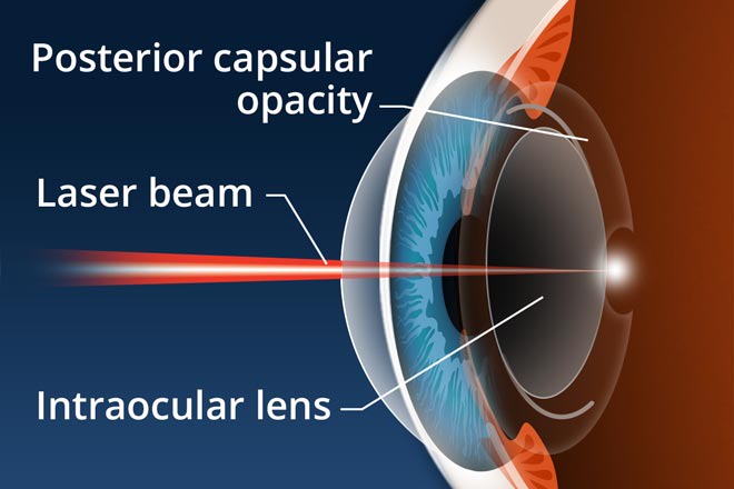 Cataract surgery complications, cataract surgery side effects