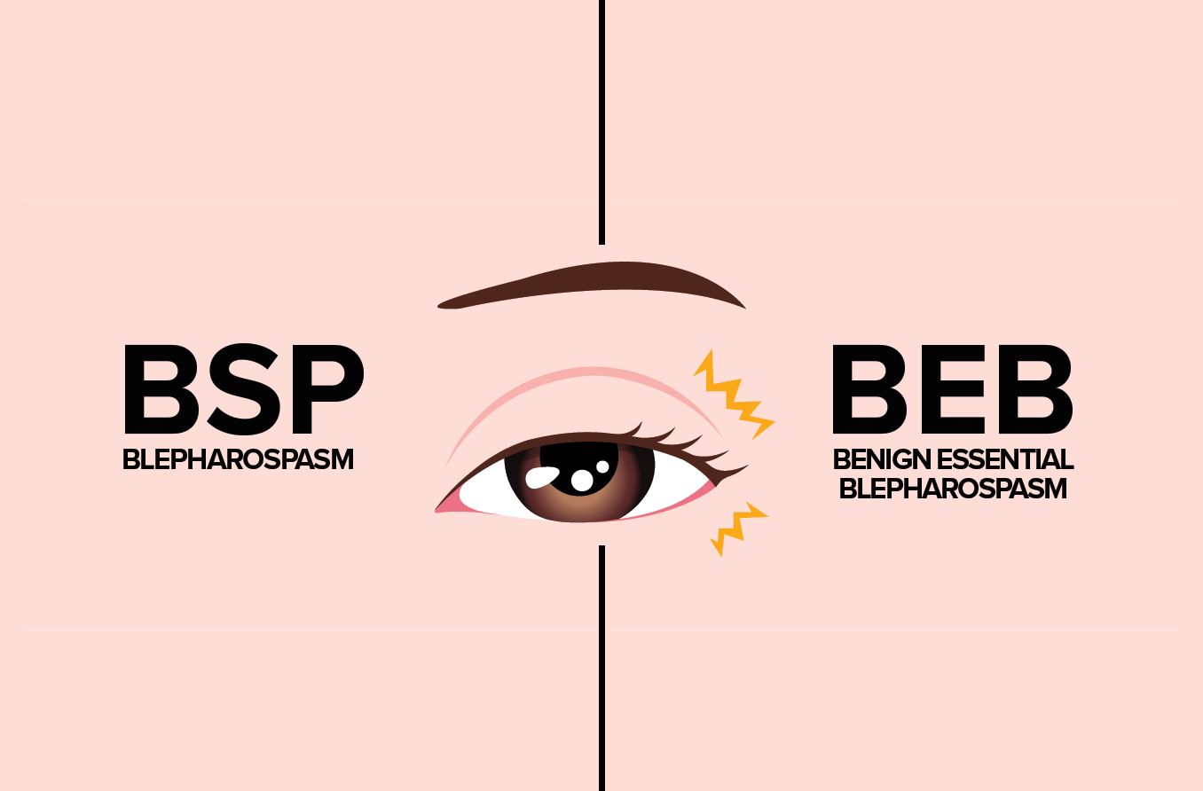 illustration of blepharospasm vs benign essential blepharospasm
