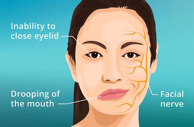 Bell's Palsy: Symptoms, Risks, Diagnosis and Treatment