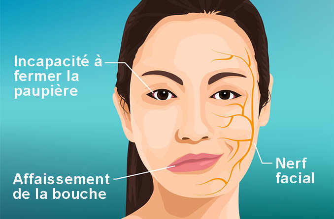 
Illustration d'une femme souffrant de symptômes de paralysie de Bell