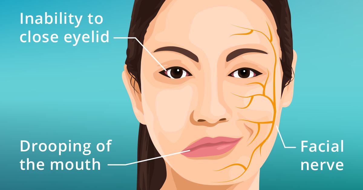 Illustration of a woman suffering from Bell's Palsy symptoms