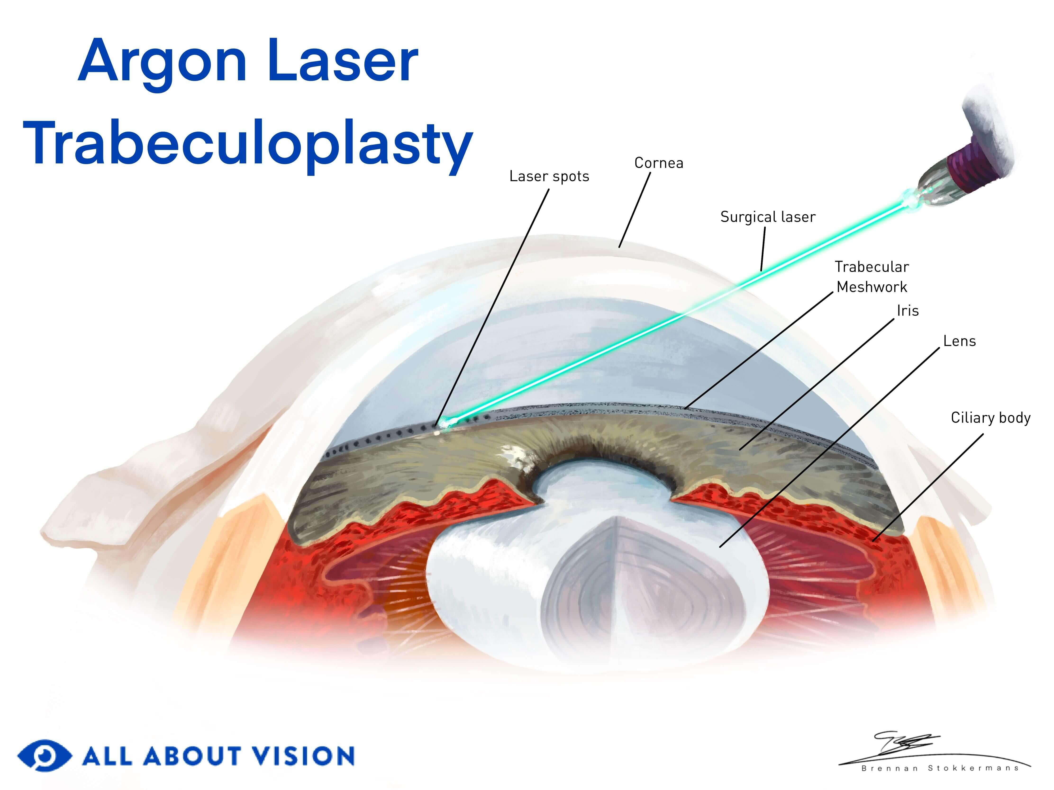 Illustration depicting effects of glaucoma surgery on the eye.