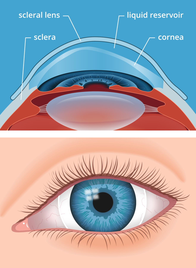 Scleral contact lenses for keratoconus and irregular corneas