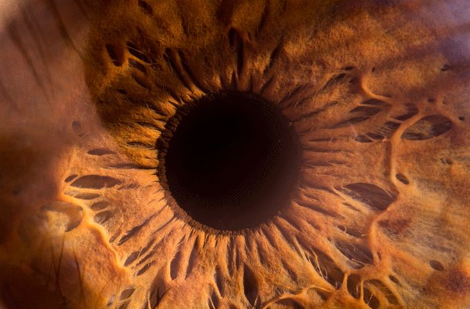 closeup of an eyeball with globe luxation