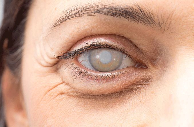 Closeup of an eye with a dense cataract
