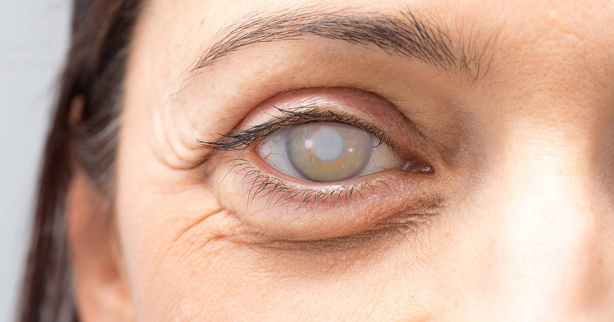 Edema Oculare Dopo Intervento Cataratta Complicazioni dopo un intervento di cataratta | All About Vision
