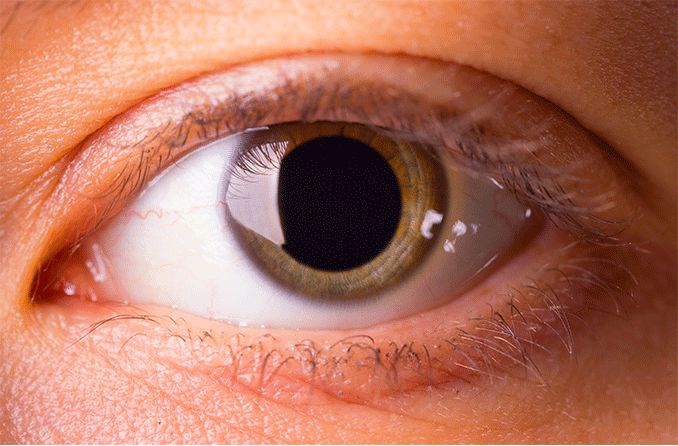 closeup of a dilated pupil or blown pupil