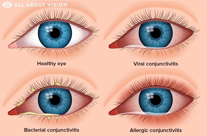 giant papillary conjunctivitis symptoms