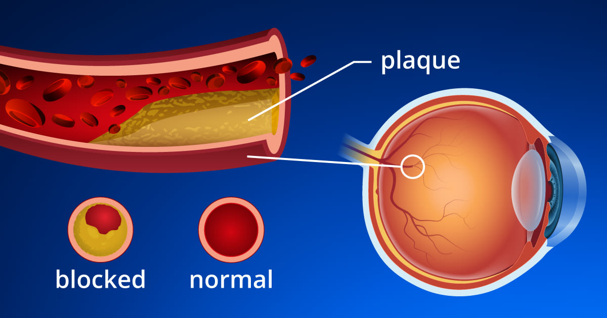 central retinal artery occlusion