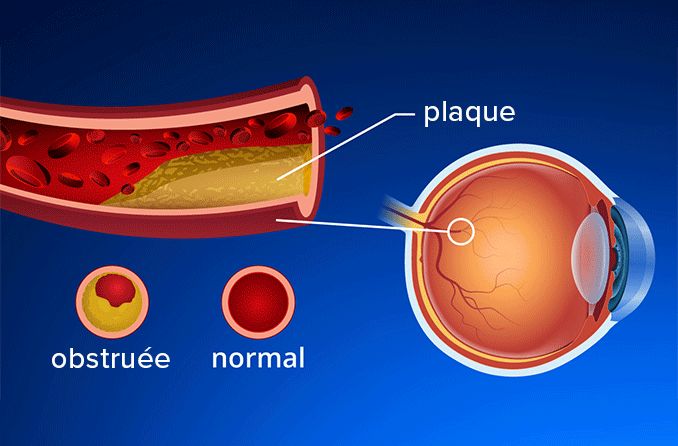 occlusion de l'artère centrale de la rétine