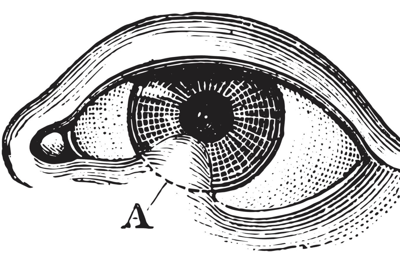Medical illustration of symblepharons of the eye