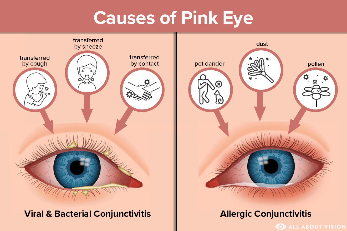 Pink Eye (Conjunctivitis) Causes - All About Vision