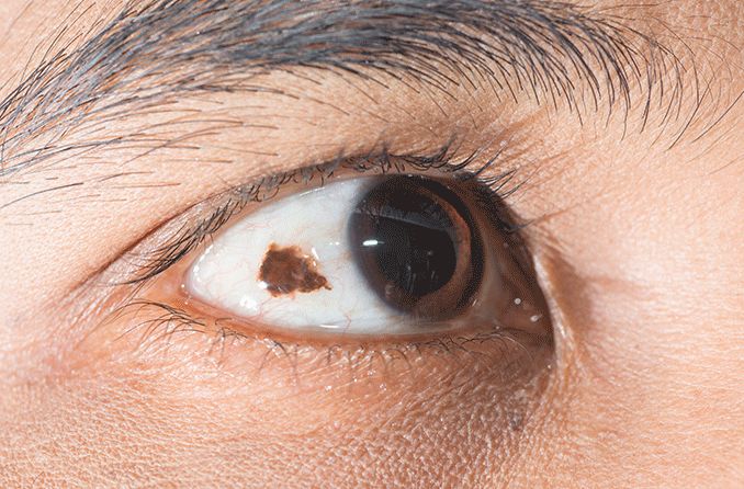 conjunctival nevus