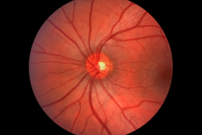 cmv retinitis