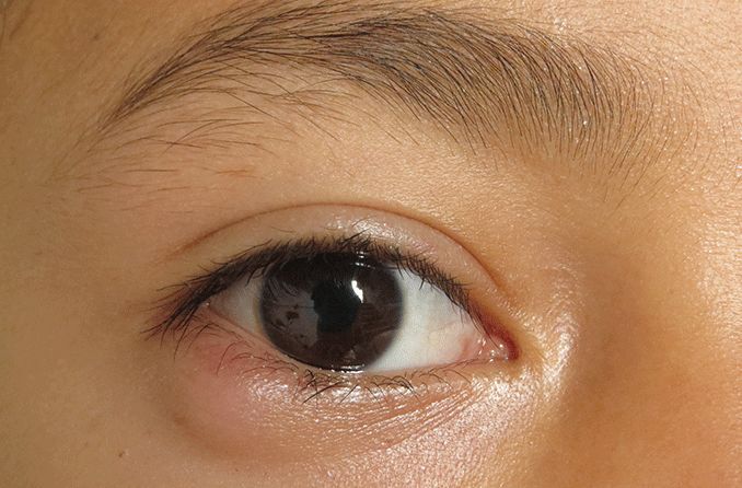 closeup of an eye with papilledema