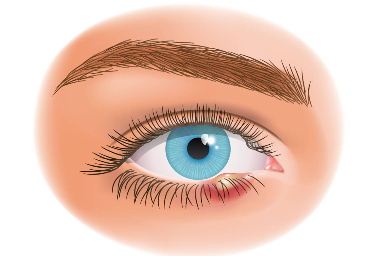 What Is A Stye (Sty) In The Eye?