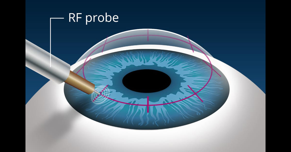 illustration of conductive keratoplasty (CK) surgery for presbyopia