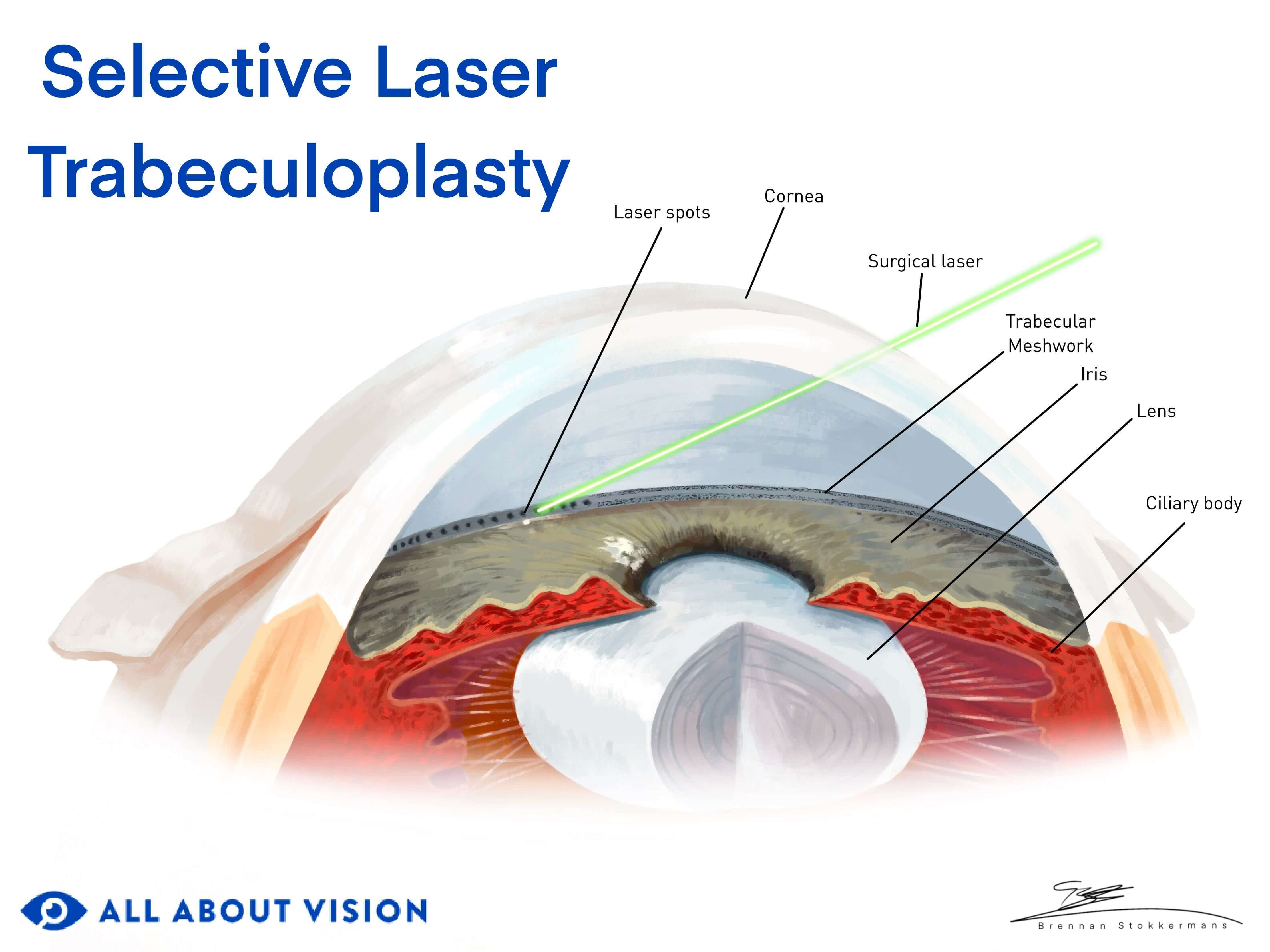 Description of Selective Laser Trabeculoplasty