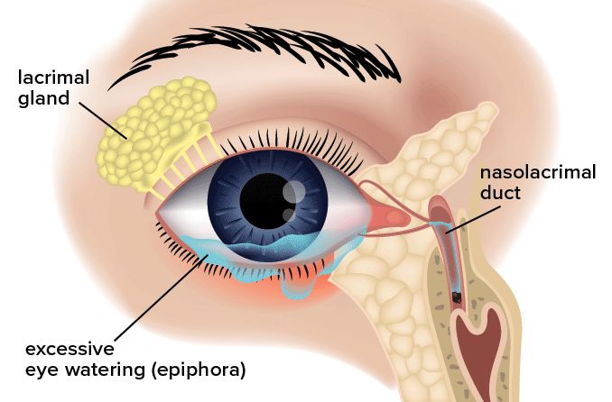 illustration of epiphora (excessive eye tearing or watering)