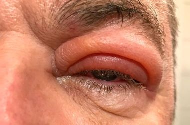 Eyelid Fungal Infection