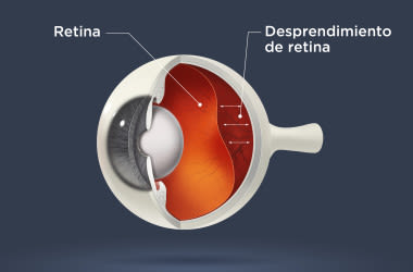 Diagrama de un desprendimiento de retina