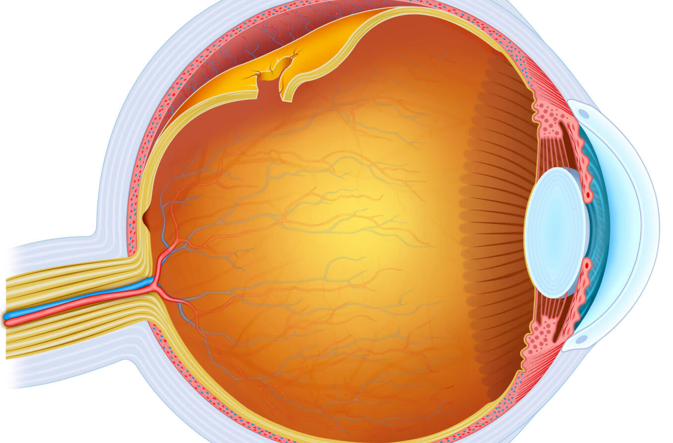 Diagrama de un desprendimiento de retina