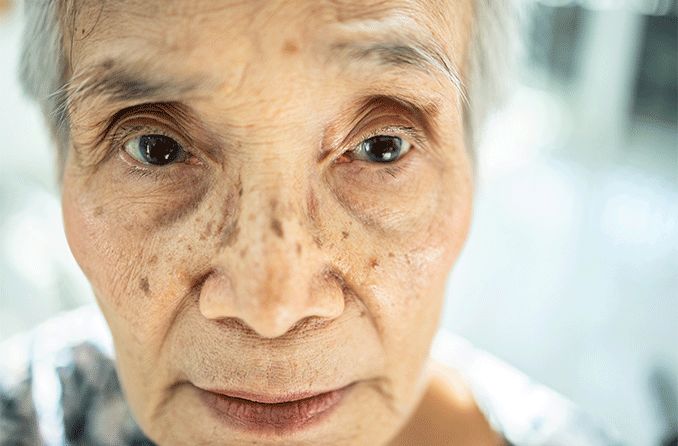 elderly woman with sunken eyes