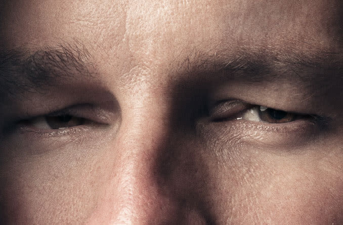 Man suffering from swollen eyelids