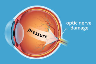 Glaucoma Symptoms Treatment And Prevention