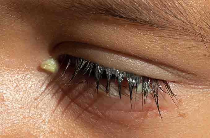 Foto de Doença De Terçol No Olho De Uma Mulher Branca e mais fotos