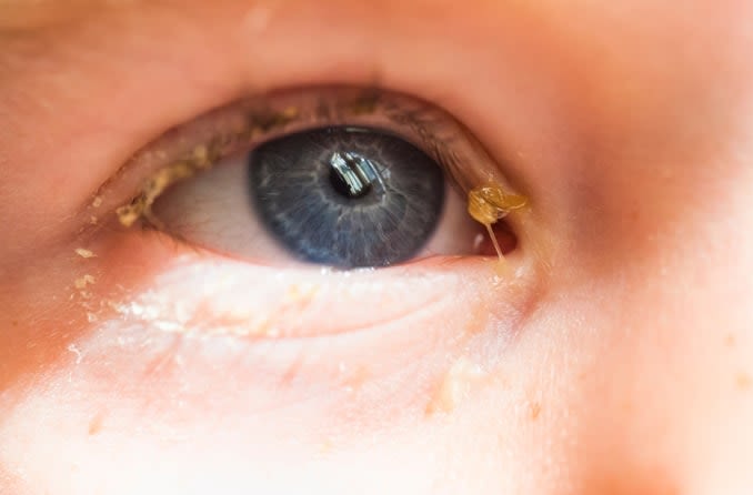 Image d'un enfant avec écoulement oculaire