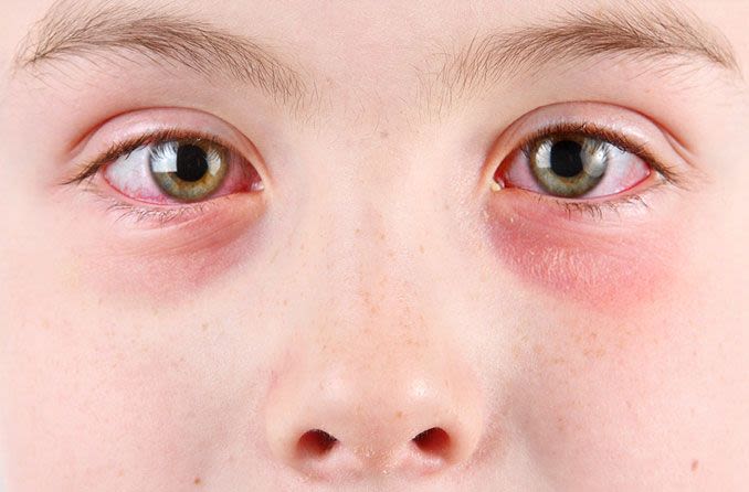 young boy with pink eye