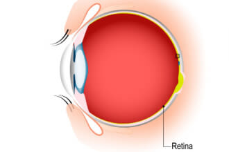Ocular Migraine Retinal Vs