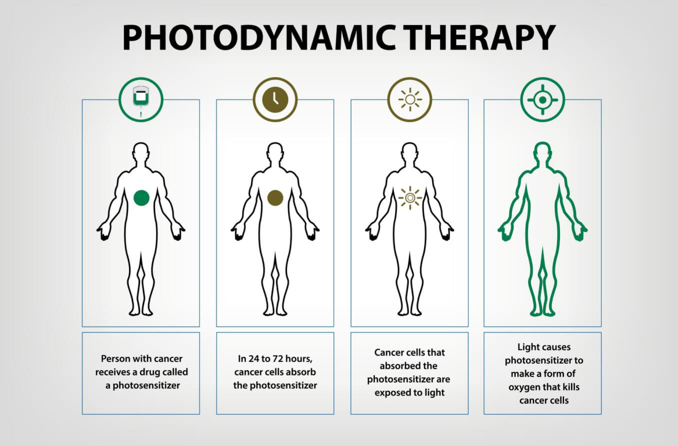 Photodynamic Therapy Cancer Treatment Vector Illustration