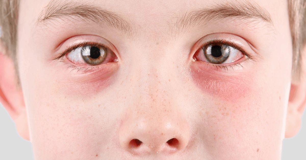 niño que sufre de conjuntivitis