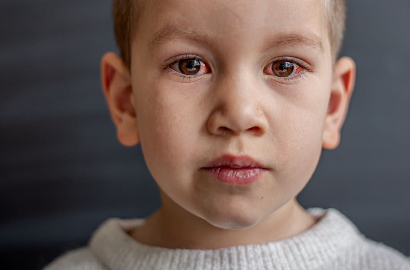 boy with pink eye