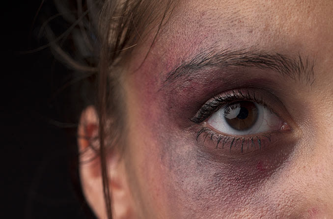 Person with black eye injury