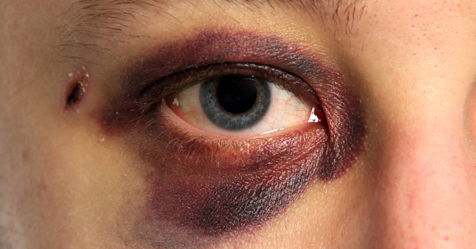 7 Common Eye Injuries And How To Treat Them