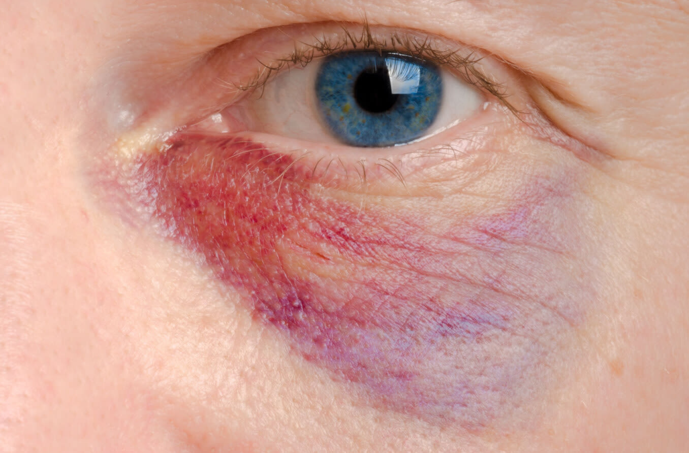 Person with black eye injury