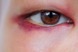 Chấn thương mắt: Hiện tượng chấn thương mắt có thể xảy ra từ nhiều nguyên nhân khác nhau. Tuy nhiên, điều quan trọng là bạn cần phải giữ gìn và bảo vệ mắt mình một cách cẩn thận hơn. Hình ảnh liên quan sẽ giúp bạn hiểu rõ hơn về các cách để bảo vệ mắt mình khỏi các chấn thương có hại.