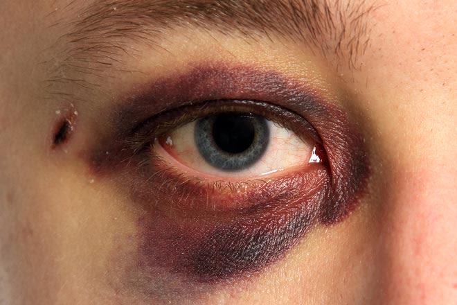 Person with black eye injury