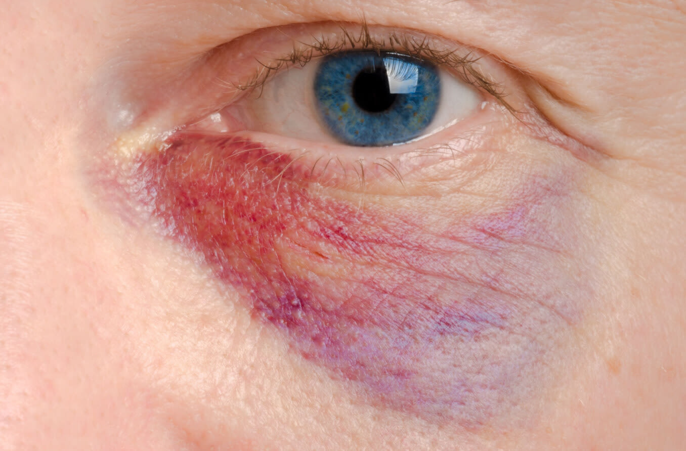 Blaues Auge mit Verfärbung im Ober- und Unterlid (Periorbitales Hämatom)