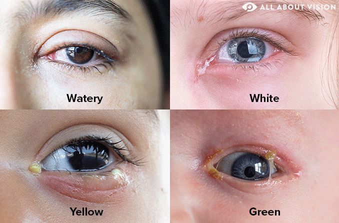 closeups of the different types of eye discharge: watery, white discharge, yellow discharge and green discharge