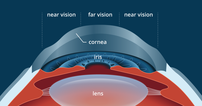 Guide to LASIK Eye and Vision Surgery - All About Vision