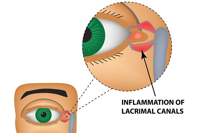 illustration of canaliculitis which is the inflammation of the lacrimal canals