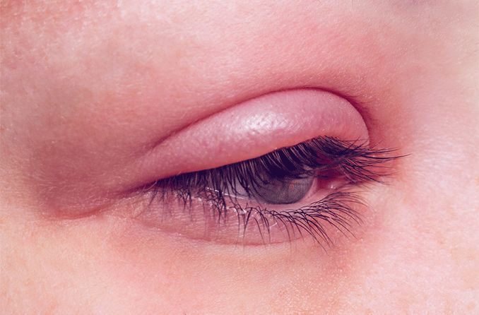 closeup of an eye infection
